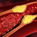 هر آنچه باید از علائم چربی خون بالا بدانید + روش های درمان