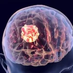 پزشکان تومور نخاعی را از حدقه‌ چشم خارج کردند