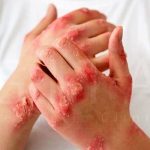 بیماری پسوریازیس چیست؟